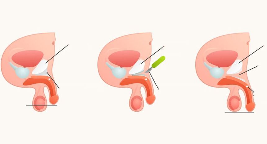 ligamentotomía para agrandar el pene